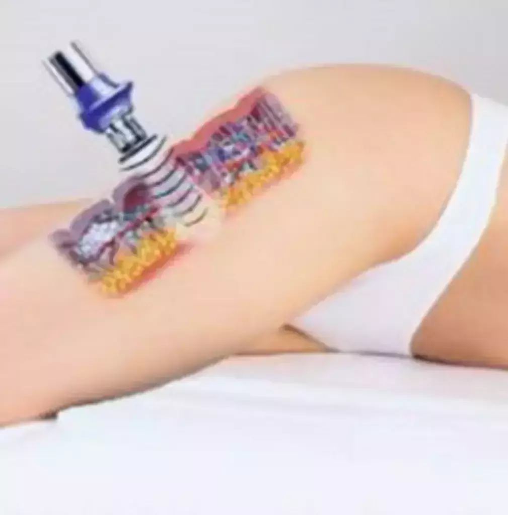 Acoustic Wave Therapy