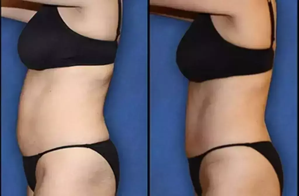Ultrasound Cavitation