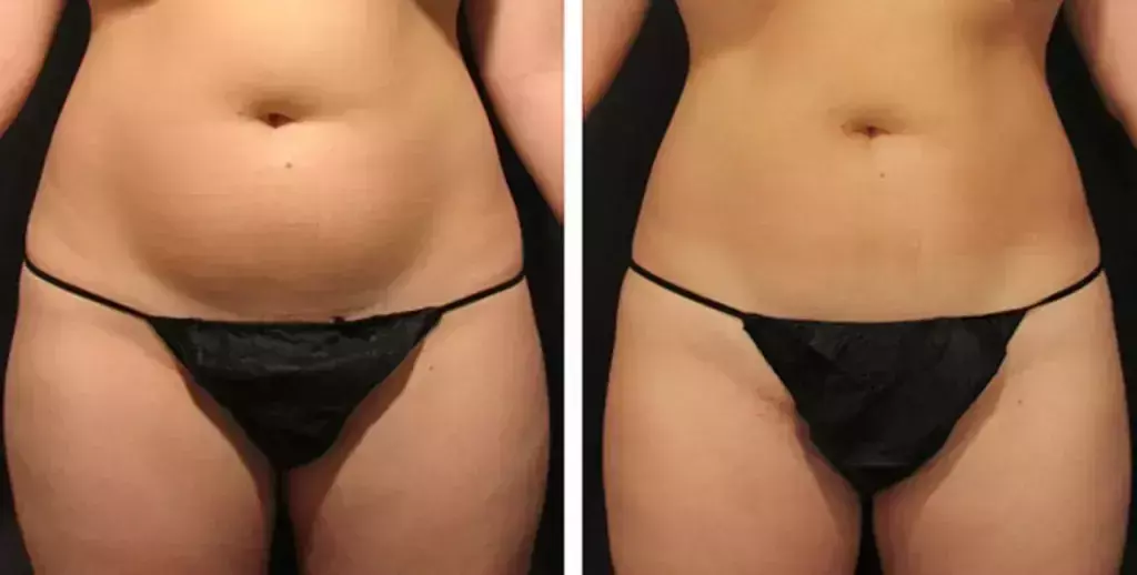 Ultrasound Cavitation